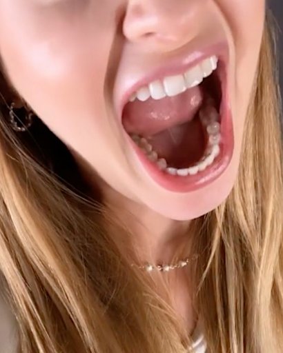 Jej nowe zęby...